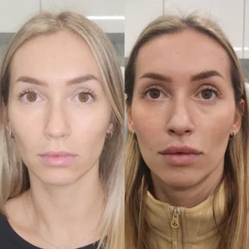 Modelowanie ust przez eksperta. Zabieg premium