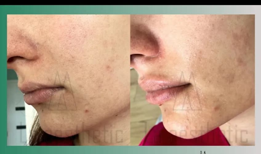 Modelowanie ust przez eksperta. Zabieg premium