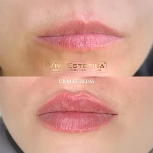 Nadanie objętości ustom. Długotrwały efekt