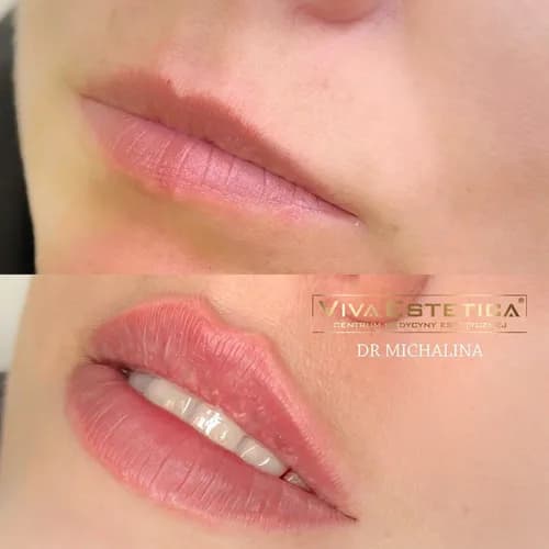 Nadanie objętości ustom. Długotrwały efekt