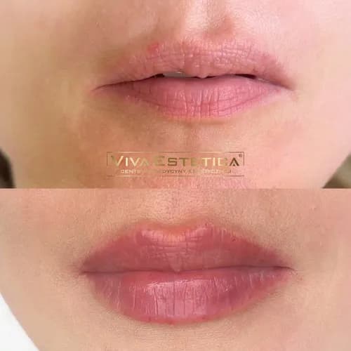 Nadanie objętości ustom. Długotrwały efekt