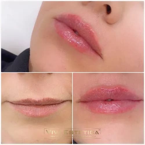 Nadanie objętości ustom. Długotrwały efekt