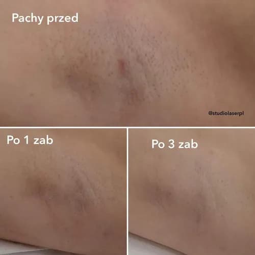 Nowoczesny laser do usuwania włosów