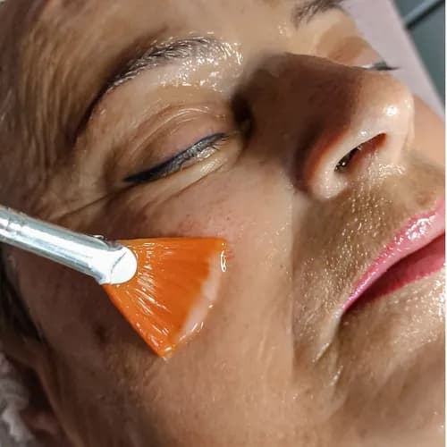 Idealny odcień skóry po peelingu chemicznym