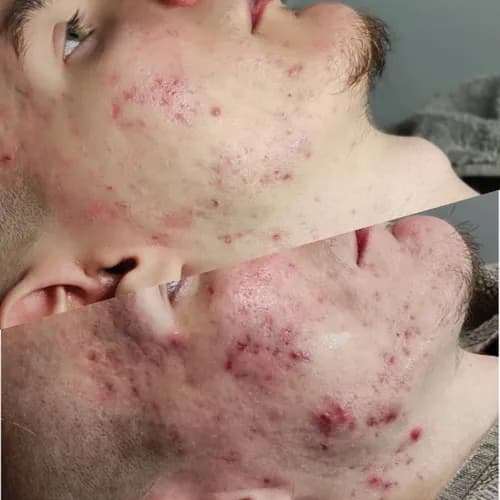 Idealny odcień skóry po peelingu chemicznym