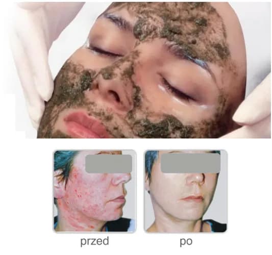 Przywrócenie zdrowia skóry