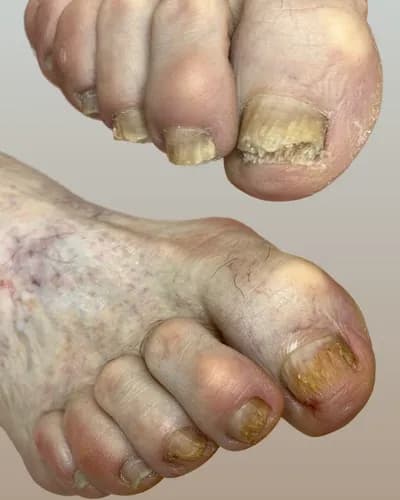 Избавьтесь от онихомикоза быстро и безболезненно