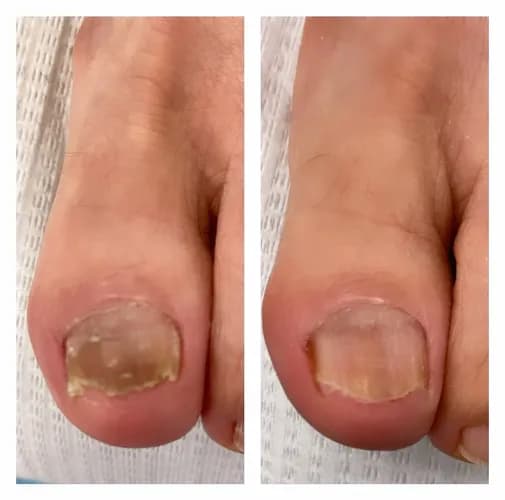 Профессиональное удаление грибка с ногтевой пластины