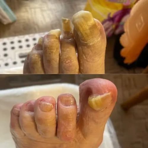 Опытный подолог: лечение грибковых заболеваний ногтей