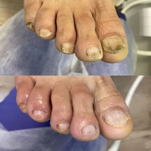 Опытный подолог: лечение грибковых заболеваний ногтей