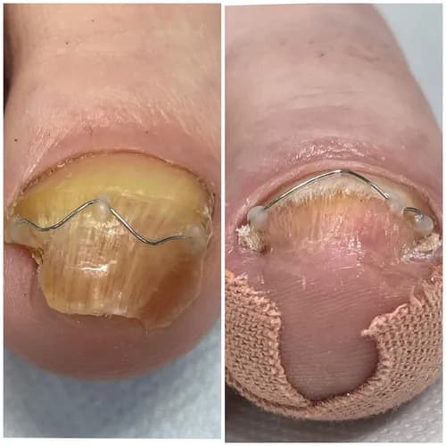 Избавим от грибка ногтей за один курс лечения