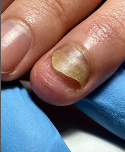 Лечение запущенного грибка ногтей - эффективные методики