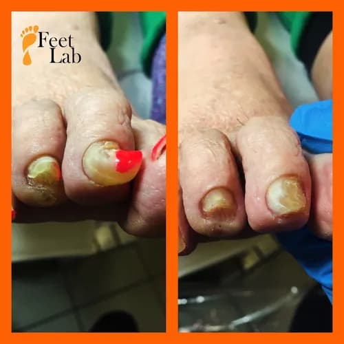 Nowoczesna terapia grzybiczych zakażeń paznokci