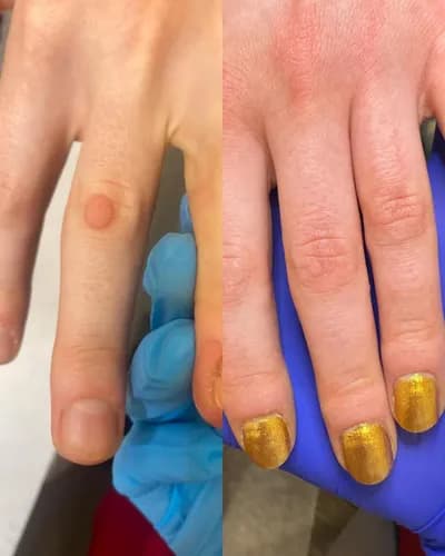 Безболезненное лечение грибковой инфекции ногтей