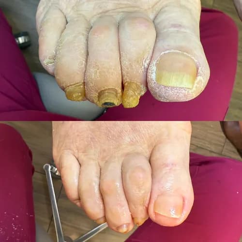 Bezbolesne leczenie infekcji grzybiczej paznokci