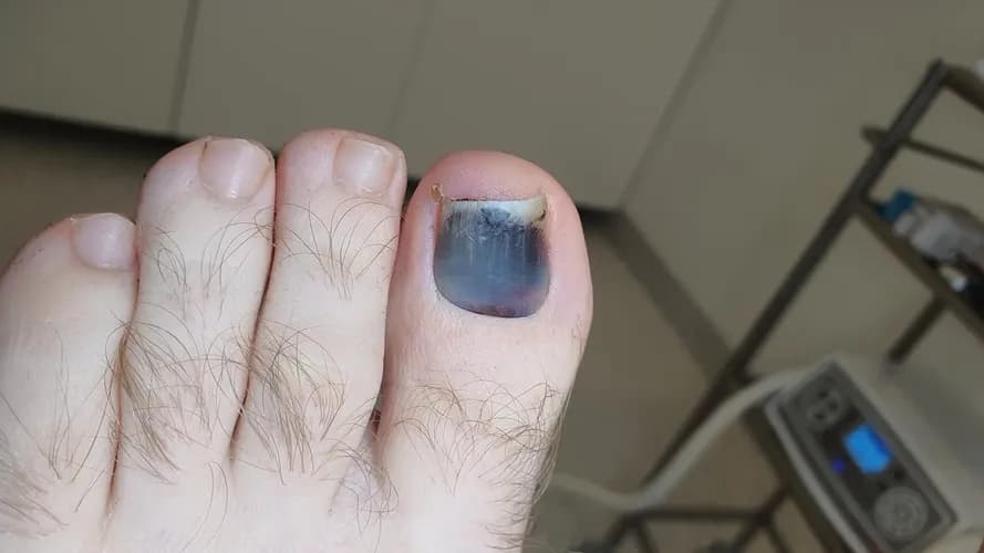 Doświadczony mykolog: leczenie grzybicy o dowolnym stopniu zaawansowania