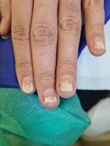 Doświadczony mykolog: leczenie grzybicy o dowolnym stopniu zaawansowania