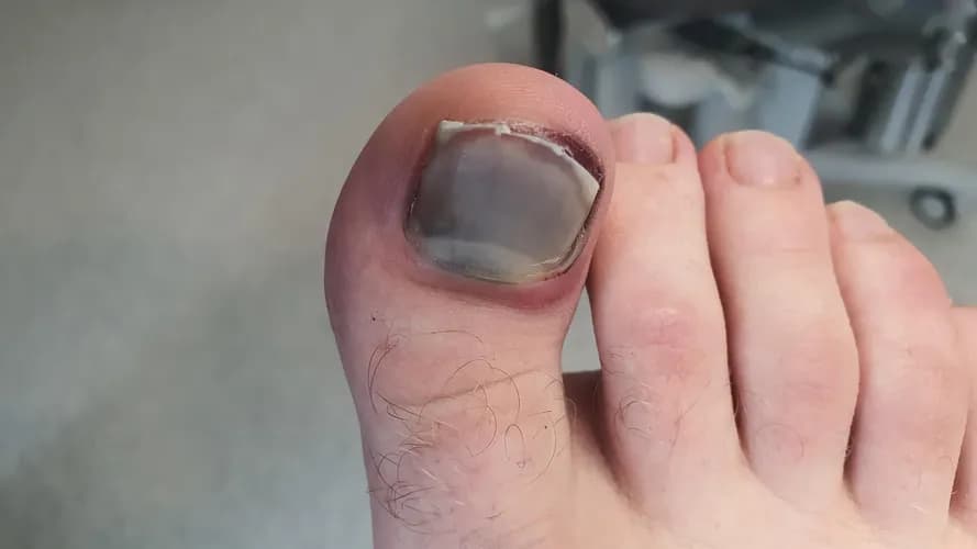 Doświadczony mykolog: leczenie grzybicy o dowolnym stopniu zaawansowania