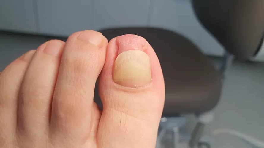 Doświadczony mykolog: leczenie grzybicy o dowolnym stopniu zaawansowania