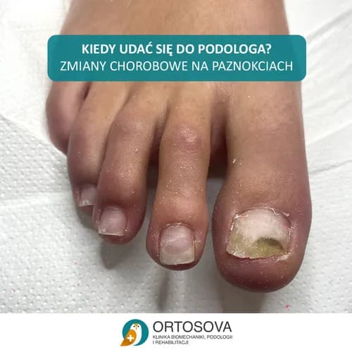 Эффективная терапия онихомикоза - запишитесь сегодня