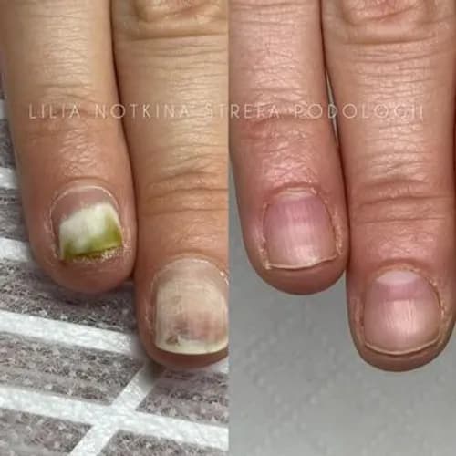 Профессиональное лечение микоза - первый приём бесплатно