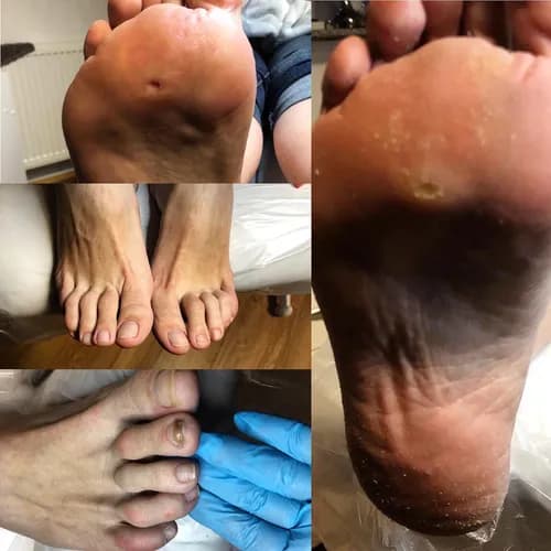 Безопасное удаление грибка с ногтевых пластин