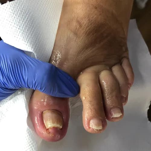 Безопасное удаление грибка с ногтевых пластин