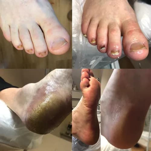 Безопасное удаление грибка с ногтевых пластин