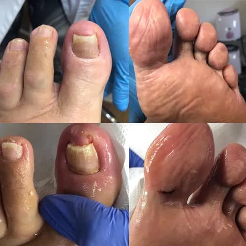 Безопасное удаление грибка с ногтевых пластин