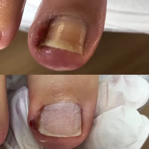 Безопасное удаление грибка с ногтевых пластин