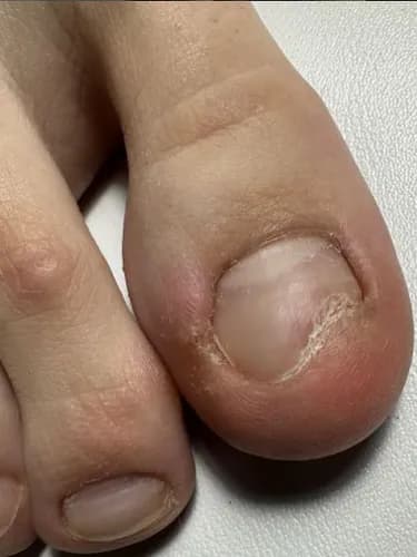 Эффективное лечение онихолизиса. Современные методики