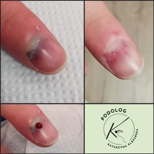 Bezpieczne leczenie odwarstwienia paznokci. Bez nawrotów