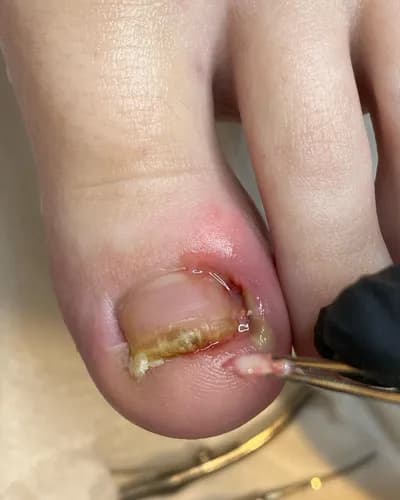 Лечение онихолизиса на современном оборудовании