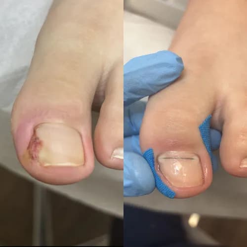 Избавляем от отслоения ногтей. Проверенные методы