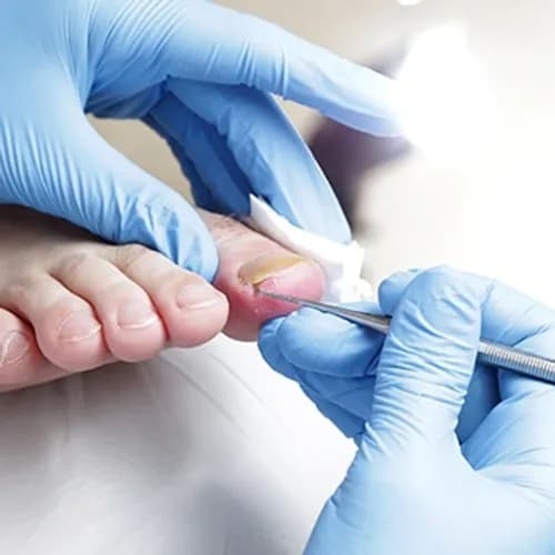 Kompleksowe podejście do leczenia onycholizy. Doświadczony lekarz