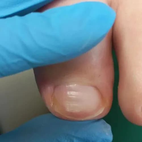 Здоровые ногти без онихолизиса. Гарантия результата