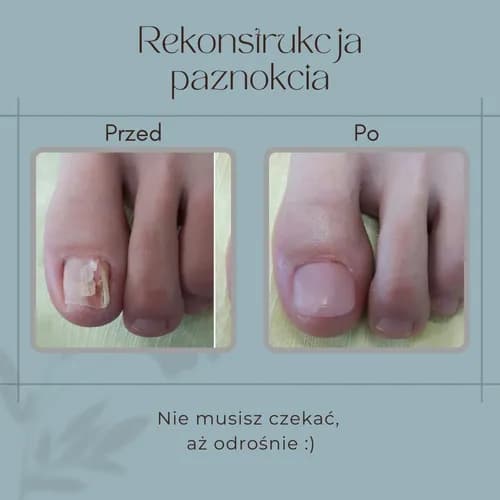 Eliminacja onycholizy. Nowoczesna diagnostyka