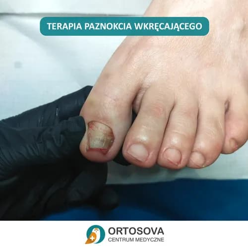 Профилактика и лечение онихолизиса. Новейшие методики