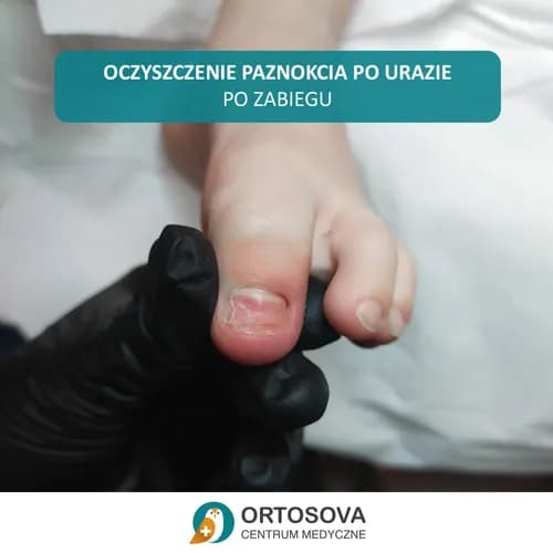 Профилактика и лечение онихолизиса. Новейшие методики