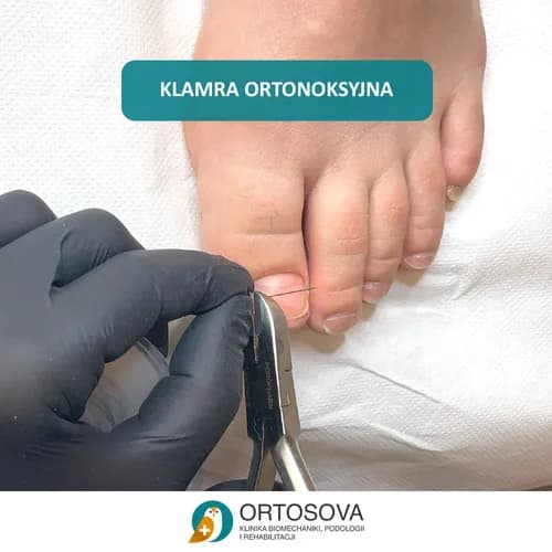 Профилактика и лечение онихолизиса. Новейшие методики