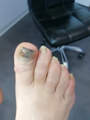 Kompleksowa terapia odwarstwienia płytki paznokcia