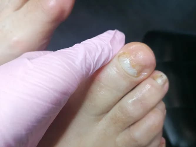 Комплексная терапия отслоения ногтевой пластины