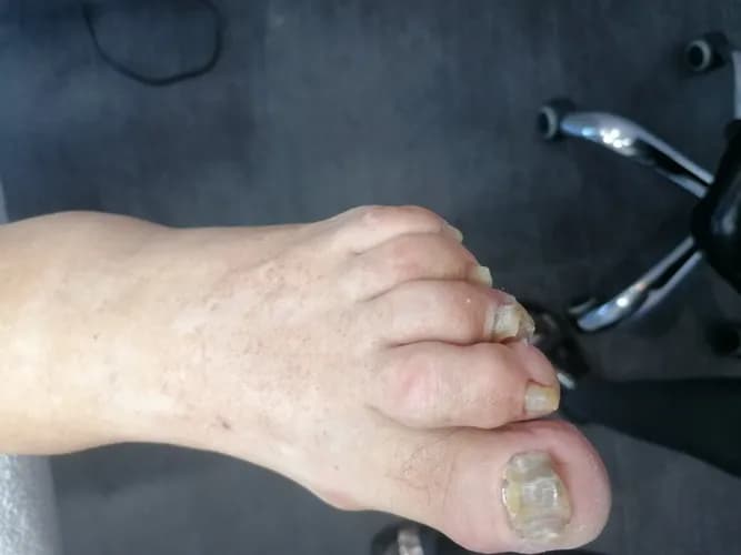 Kompleksowa terapia odwarstwienia płytki paznokcia