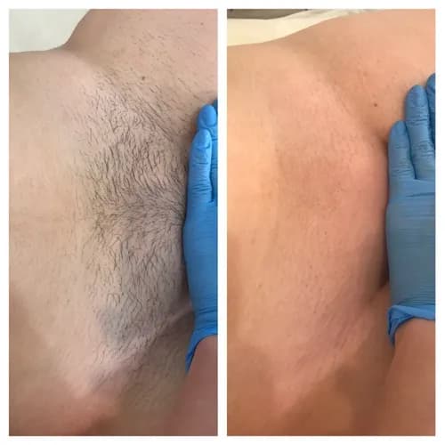 Delikatny shugaring: bezbolesne głębokie bikini.