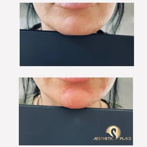 Rzeźbienie twarzy: sztuka konturowej plastyki