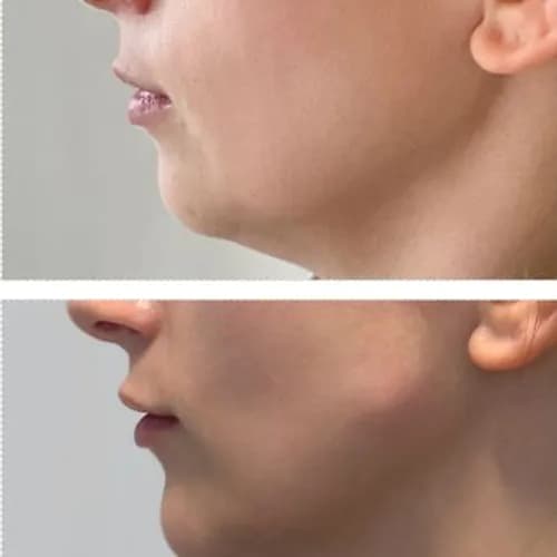 Bezoperacyjny lifting: konturowe modelowanie twarzy