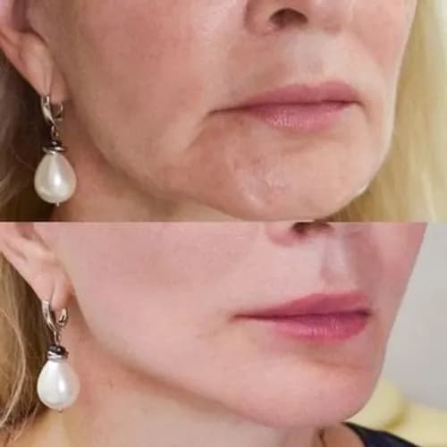 Bezoperacyjny lifting: konturowe modelowanie twarzy