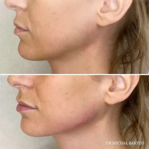 Konturowa plastyka bruzd nosowo-wargowych: minus 10 lat w godzinę