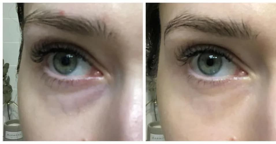 Zastrzyki piękna: botoks dla naturalnego odmłodzenia