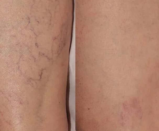 Ботокс для идеального лба: стирая следы времени